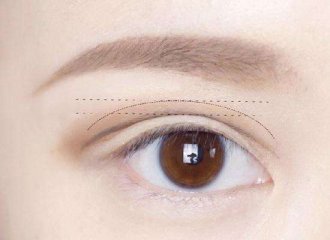 北京双眼皮手术多少钱？