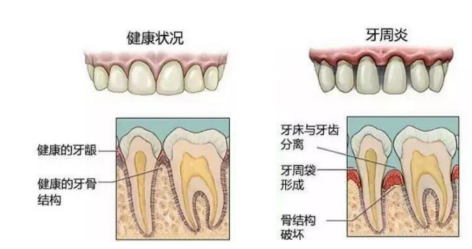 牙周炎是怎么造成的