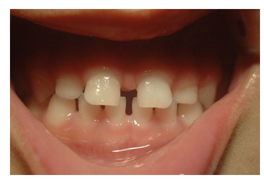 口腔牙科老鼠牙治疗