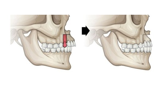 牙齿矫正丨如何辨别自己的嘴突类型呢